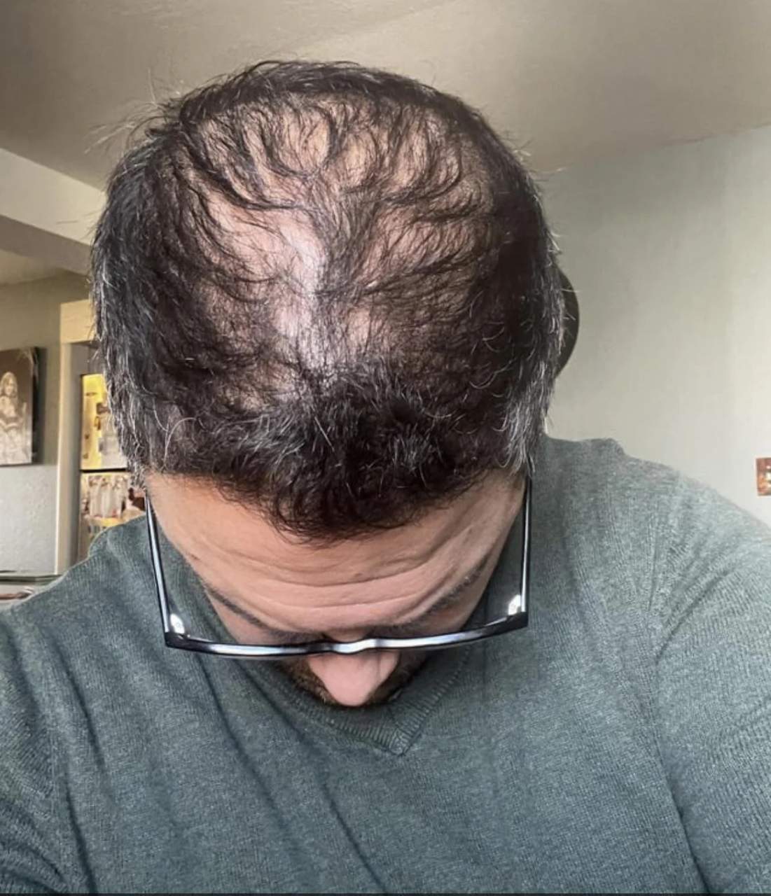 Finasteride T Pico En M Xico